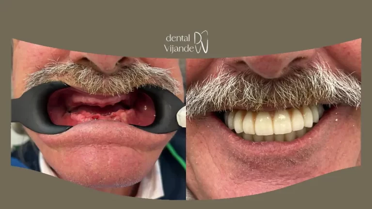 Rehabilitación oral con implantes en Coín y Cártama