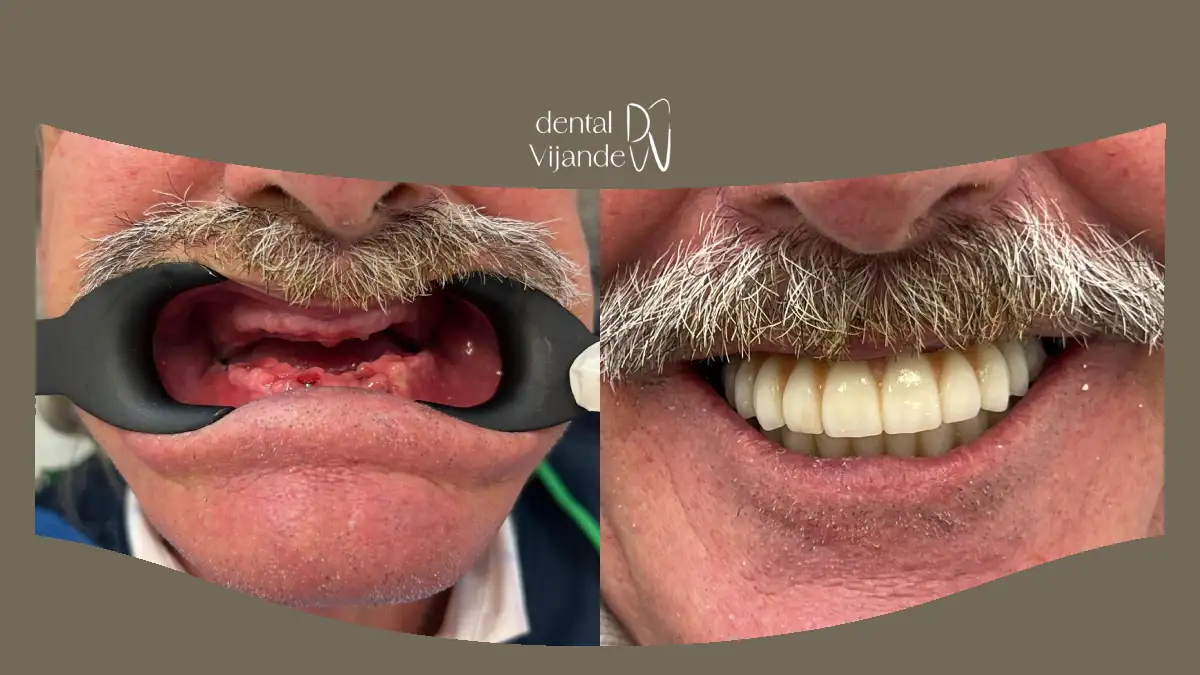 Rehabilitación oral con implantes en Coín y Cártama