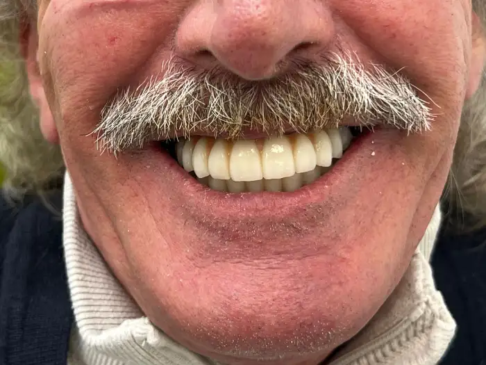 prótesis fija sobre implantes